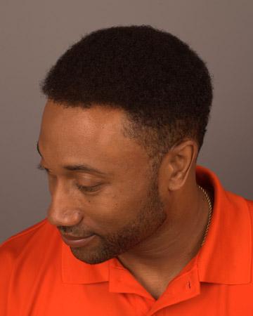 06 Sensigraft Before and After Photo 01 solutions mens gallery sensigraft 06 Sensigraft Before and After Photo 01